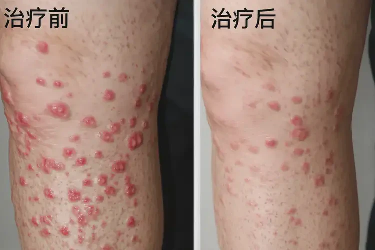 男人大腿出湿疹可以治好吗(图4)