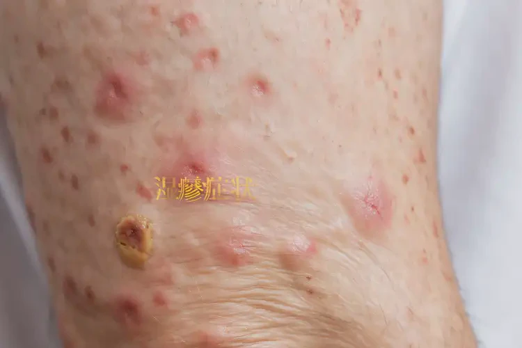 男人身上偶尔长湿疹可以治好吗(图4)