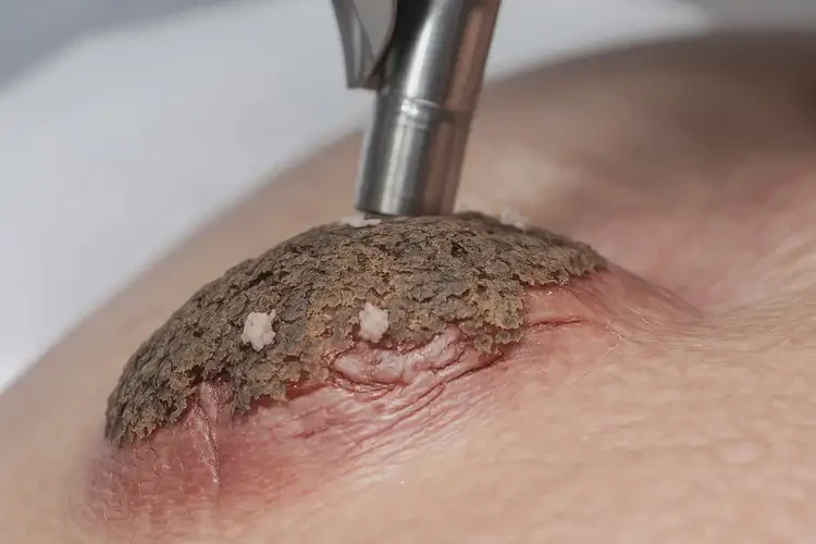 青年人大腿有湿疹可以治好吗(图2)