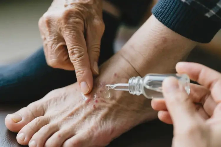 高龄老人脚上起湿疹可以治好吗(图1)