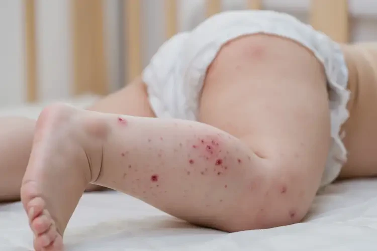 婴儿肛周容易起湿疹能治好吗(图4)