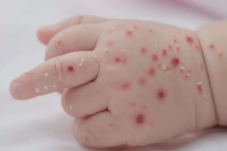 婴儿手上经常起湿疹能治好吗(图4)