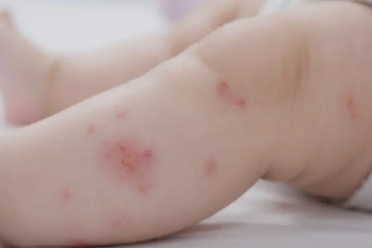 宝宝小腿上偶尔起湿疹能治好吗(图4)