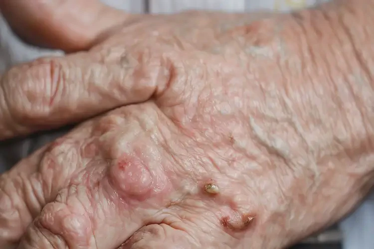 老年人手上偶尔起湿疹可以彻底自愈吗(图4)