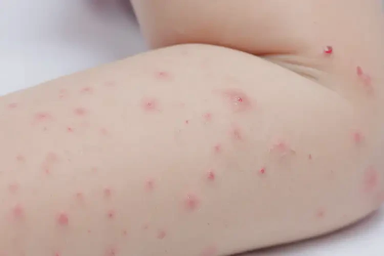 儿童屁股上出现湿疹能够彻底治愈吗(图4)