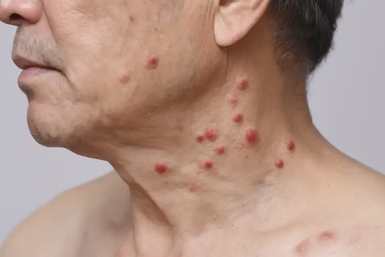 男人脖子出现湿疹可以治好吗(图4)