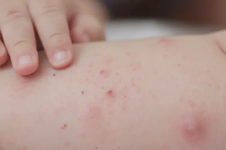 宝宝屁股容易起湿疹可不可以彻底自愈(图4)