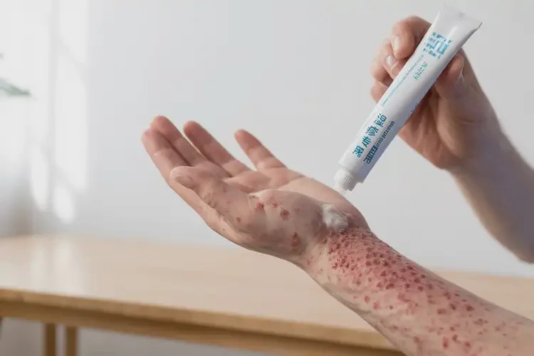 女人手上经常长湿疹能不能彻底自愈(图3)