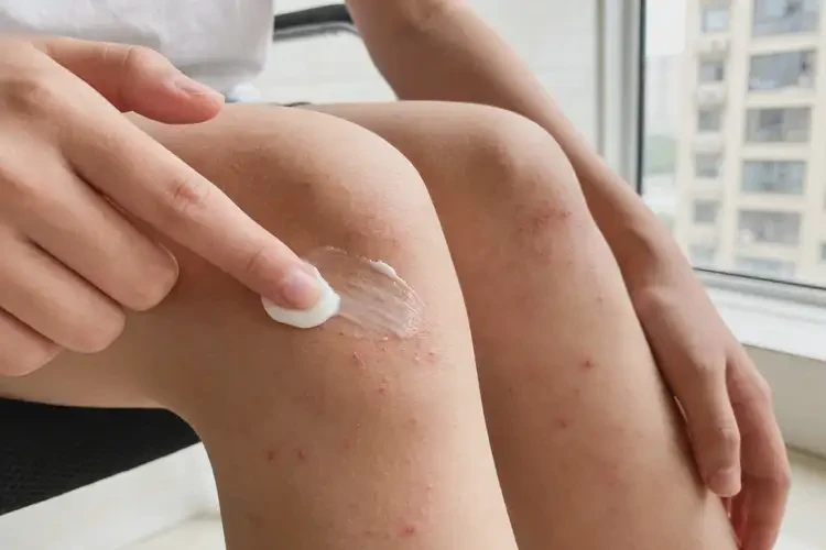 青少年四肢长湿疹不管它会自己好吗(图1)