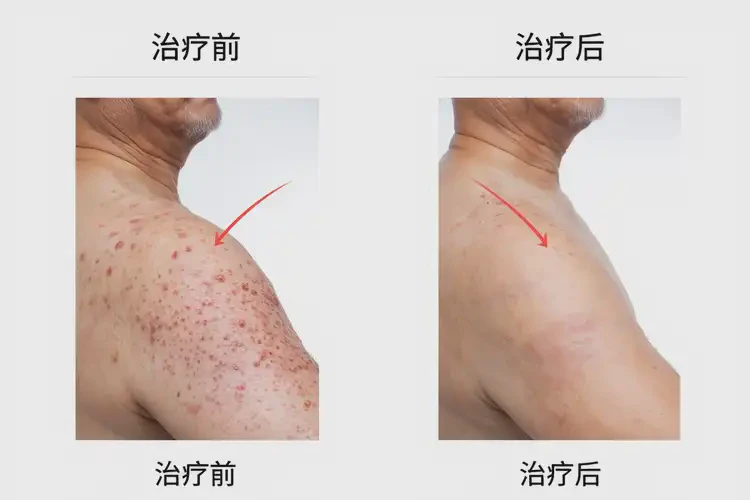 男性身上出湿疹可以治好吗(图4)