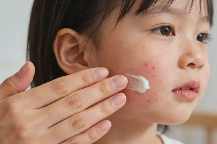 少儿面部偶尔起湿疹可以彻底自愈吗(图2)