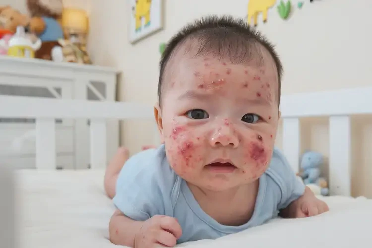 小儿面部长湿疹可以治好吗(图4)