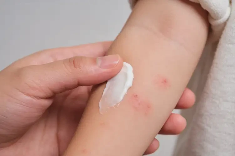 儿童手臂经常起湿疹可不可以彻底自愈(图1)