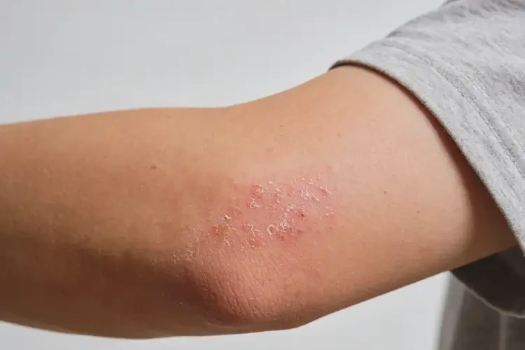 男人手臂上容易起湿疹可以治好吗(图1)