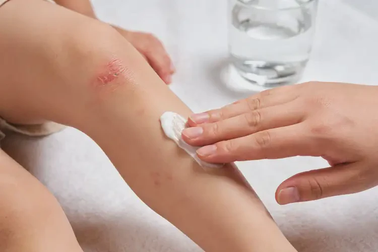 儿童小腿上偶尔起湿疹能靠自己自愈吗(图1)