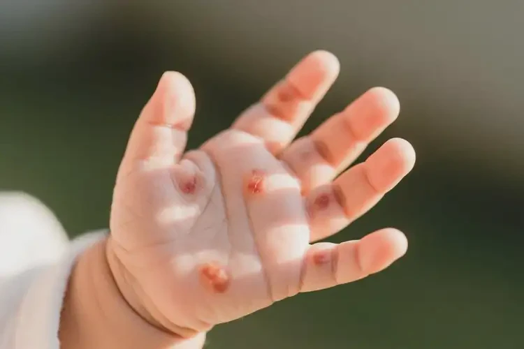 婴儿身上容易长湿疹能治好吗(图4)