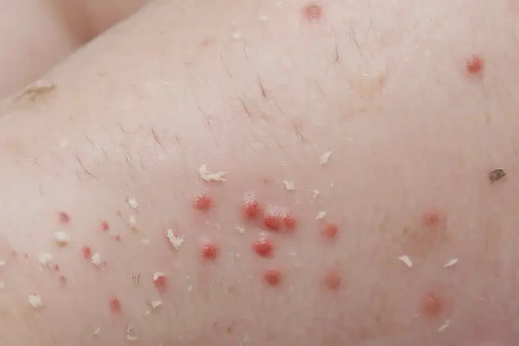 小儿脚上偶尔长湿疹可以治好吗(图4)