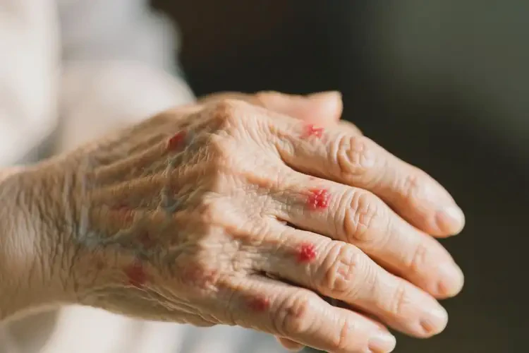 高龄老人手上偶尔起湿疹可以治好吗(图4)