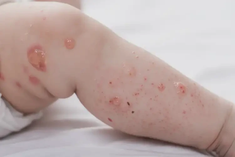 宝宝小腿偶尔长湿疹能治好吗(图4)