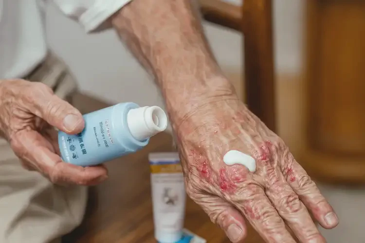 高龄老人手上有湿疹可以治好吗(图3)