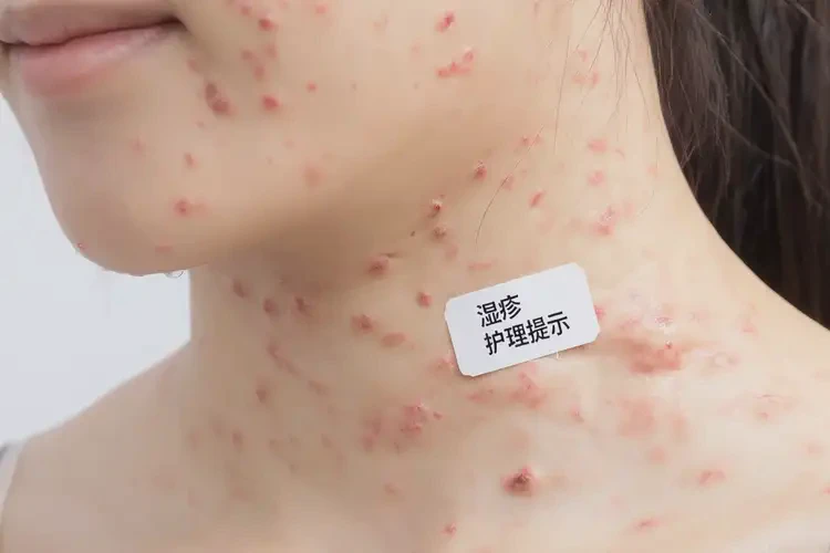 女生脖子上长湿疹能彻底自愈吗(图4)