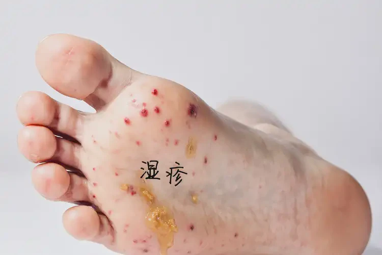 男人脚上起湿疹可以治好吗(图4)