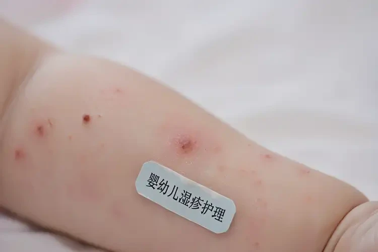 婴幼儿手臂出湿疹能治好吗(图4)