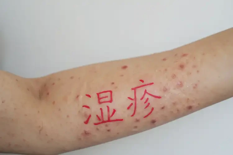 女人手臂出湿疹可以治好吗(图4)