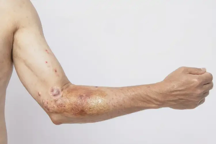 男人手臂经常起湿疹可以治好吗(图3)