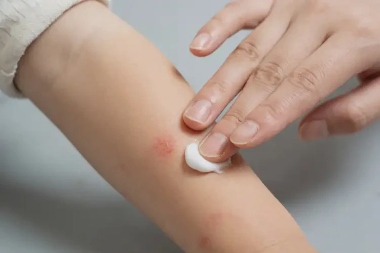 儿童手臂经常起湿疹可不可以彻底自愈(图4)