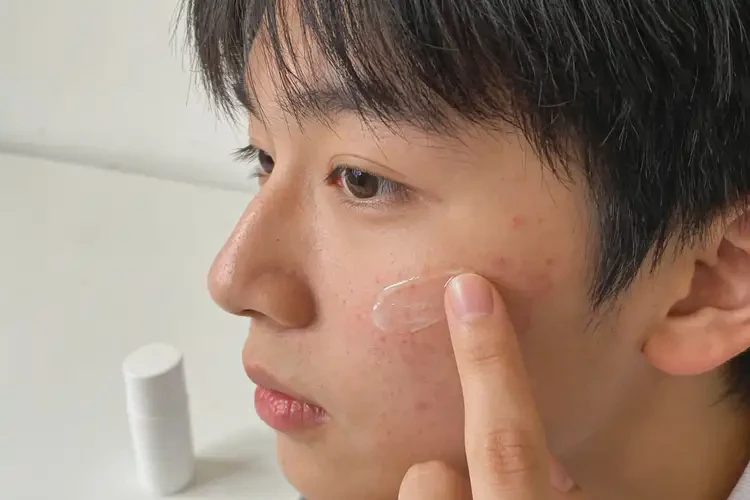 大学生面部出湿疹可不可以彻底自愈(图3)