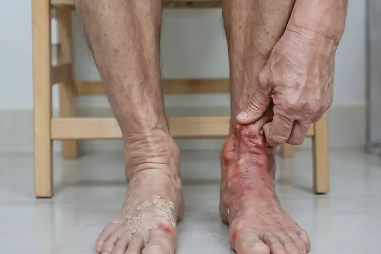 高龄老人脚上出湿疹能彻底自愈吗(图4)