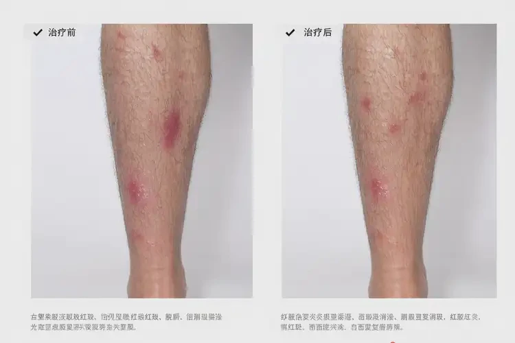 男人小腿起湿疹可以治好吗(图4)
