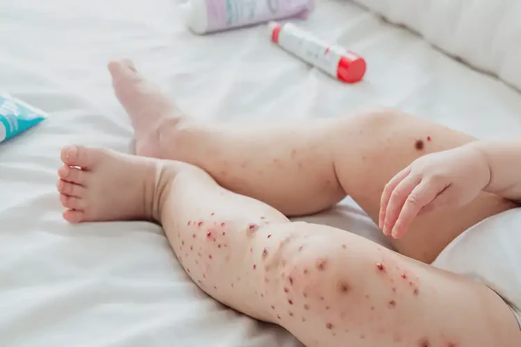 宝宝大腿容易起湿疹能治好吗(图4)