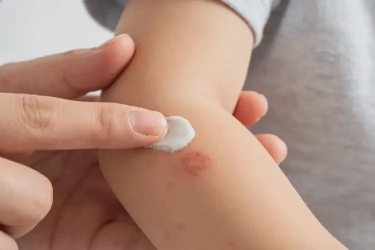 儿童手臂经常起湿疹可不可以彻底自愈(图3)