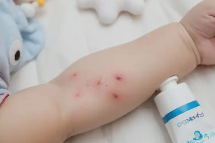宝宝手臂上有湿疹能治好吗(图4)
