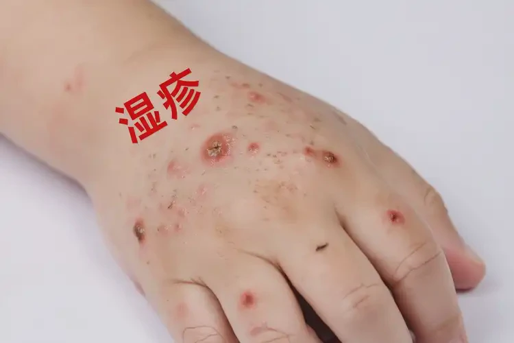 儿童手上有湿疹不管它会自己痊愈吗(图4)