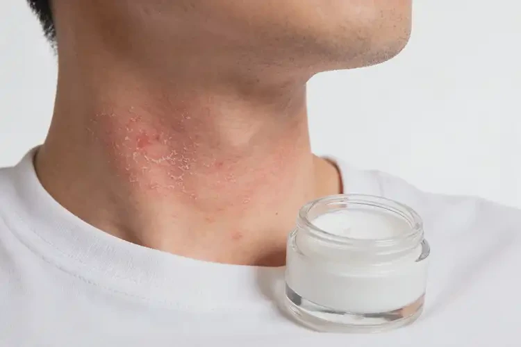 男人脖子上出现湿疹可以治好吗(图1)