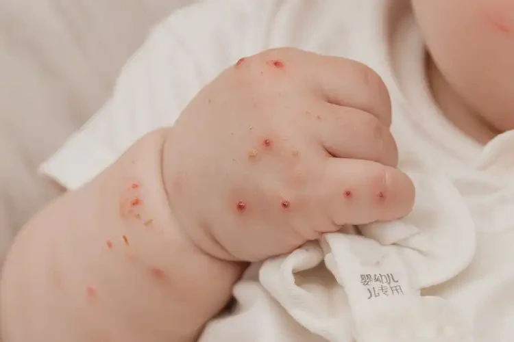 宝宝手上长湿疹不管它会自己好吗(图2)