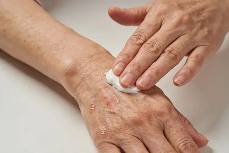 老年人手上容易起湿疹不管它会自己痊愈吗(图1)