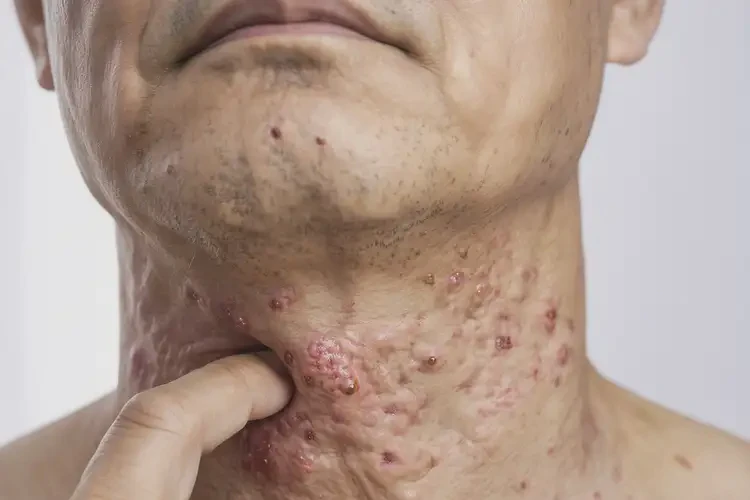 男人脖子上偶尔长湿疹可以治好吗(图4)