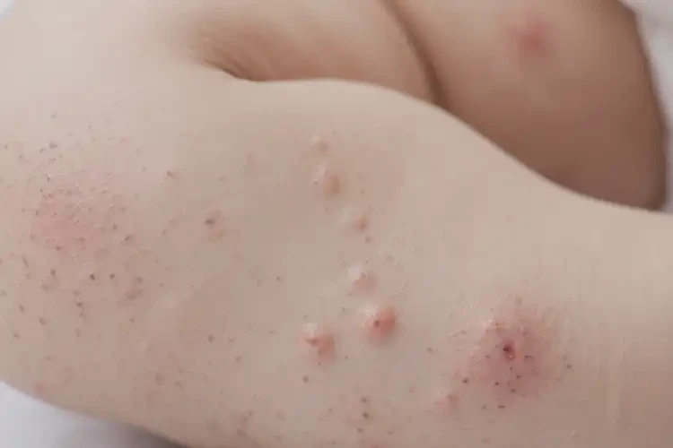 婴儿小腿上经常长湿疹能治好吗(图4)