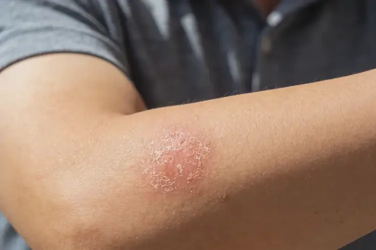 男人手臂上容易起湿疹可以治好吗(图2)