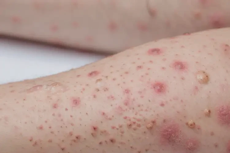 青少年屁股上经常长湿疹可以治好吗(图4)