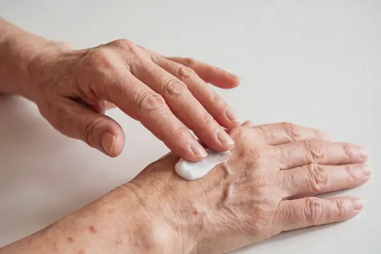 老年人手上出现湿疹不管它会自己痊愈吗(图2)