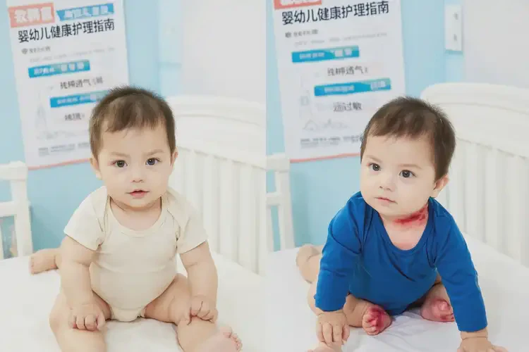 婴幼儿脖子起湿疹能治好吗(图2)