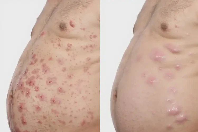 男人肚子上容易起湿疹可以治好吗(图3)