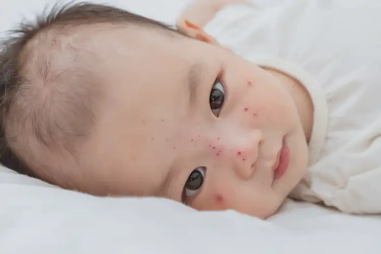 宝宝脸上偶尔起湿疹不管它会自己自愈吗(图4)