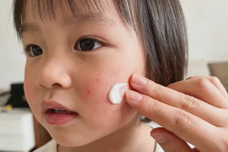 少儿面部偶尔起湿疹可以彻底自愈吗(图1)