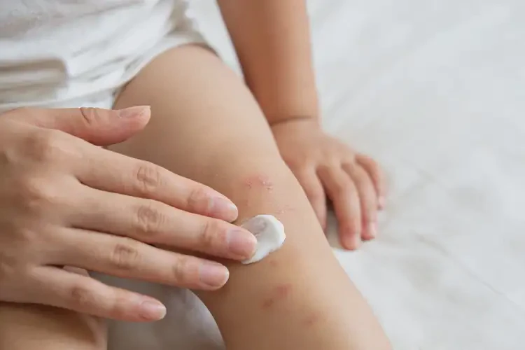 幼儿小腿上经常起湿疹能不能彻底自愈(图4)